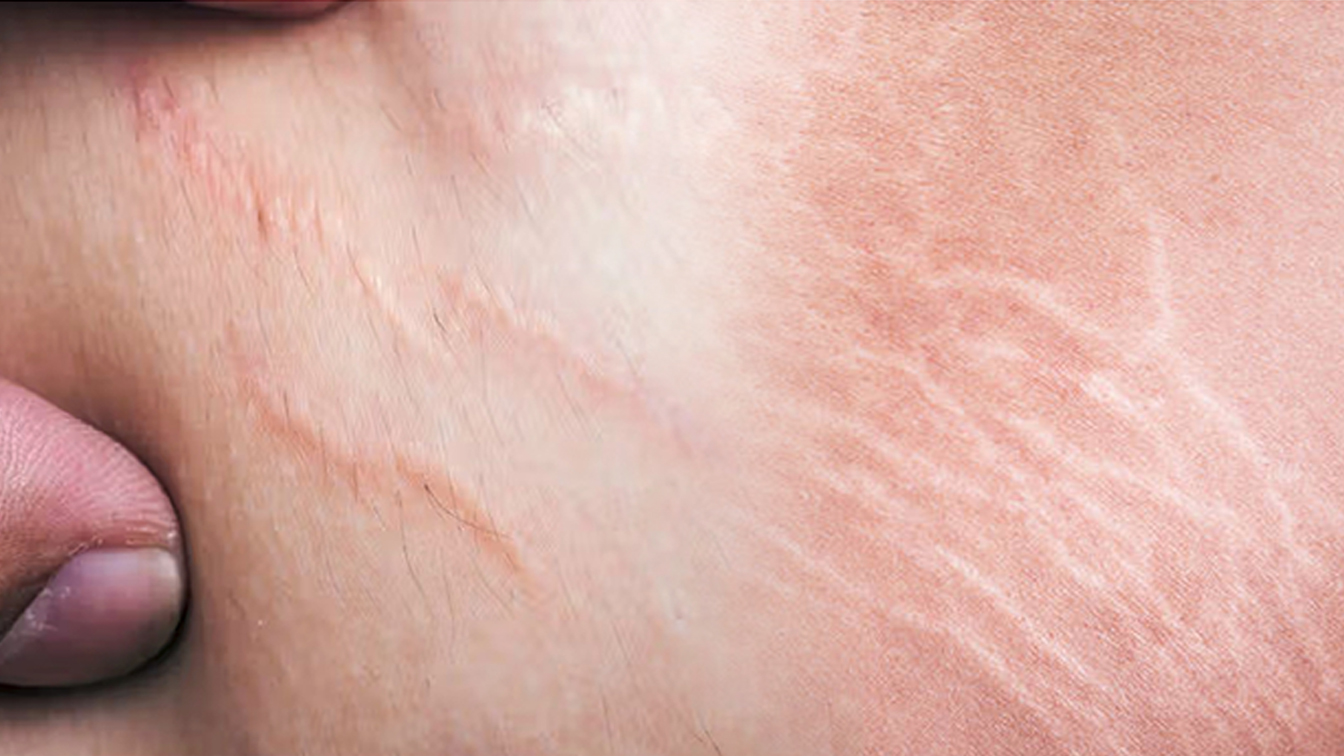 গর্ভাবস্থায় স্ট্রেচ মার্ক: কারণ, প্রতিরোধ ও যত্নের সঠিক উপায়